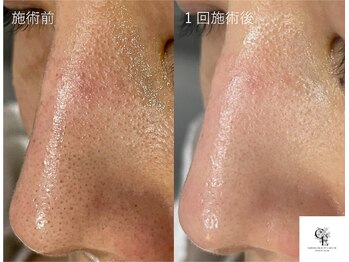 チエミ(Chi e mi)/黒ずみ毛穴・角栓・乾燥改善