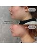【お顔の脂肪を減らしたい方へ】照射2倍！切らない小顔リフト ¥33,000