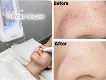 トータルビューティー airの雰囲気（大人気ハイドロスプラッシュ！水素の力で古い角質を除去★）