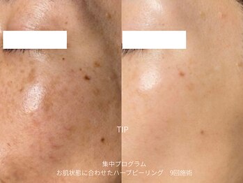 サロンサイ(salonsai)の写真/シミ・しわ予防にも◎艶と透明感を育てる、大人のための上質な肌管理★