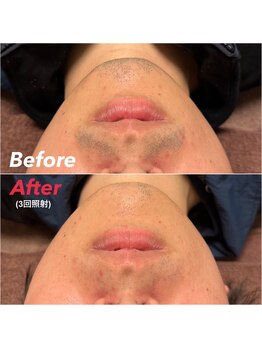 スーパースカルプ 大津店(SuperScalp)/ヒゲ脱毛3回時点before/after
