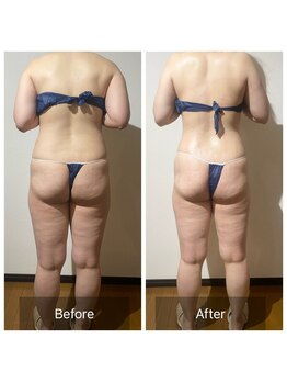 リノリー 古川店(rinory)/【大人気】レメディー×脂肪冷却