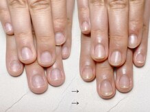 スマイルニコ(smile nico)/深爪矯正　自爪風長さ出し