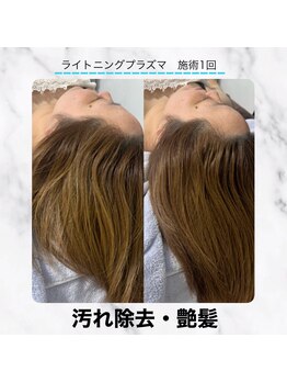 エクラ 六本木(eclat)/プラズマスカルプ