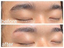 クラシックス(CLASSICS)/眉毛脱毛