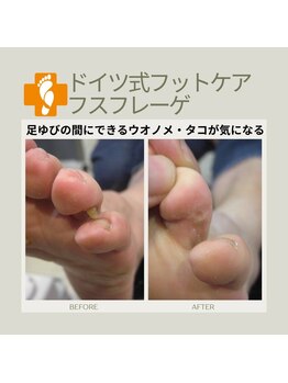 フスフレーゲ 学芸大学店/指の間のお悩み