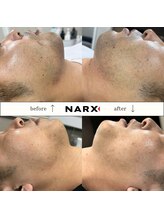 ナークス(NARX)/【ヒゲ脱毛】ビフォーアフター