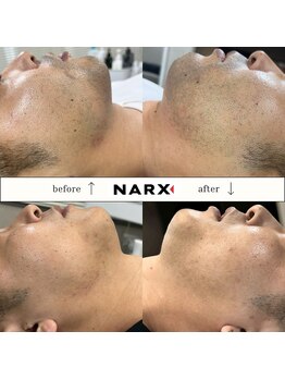 ナークス(NARX)/【ヒゲ脱毛】ビフォーアフター