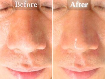 ボーンオム(Born Homme)/毛穴洗浄＋美容液導入：40代男性