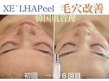 ロージースマイル(Rosy smile)の写真/黒ずみ・詰まりごっそり除去！透明肌へ♪ 【ハイドラ美容液毛穴洗浄】【韓国発　XE`LHAPeel (セラピール】