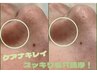 【究極毛穴コース】がんこな角栓ごっそり除去+EMSで小顔ケア