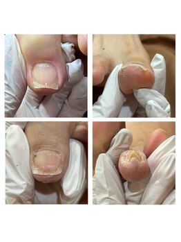 なべ整骨院の写真/「自分は巻き爪なのかな？」「爪が痛いけどなぜだろう？」そんなお悩みにもお答えさせて頂きます♪