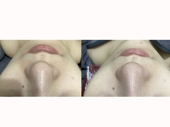 ルボン(RUBON)/毛穴