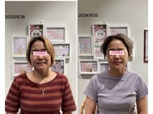 アネラ(ANERA)/小顔矯正&毛穴洗浄BeforeAfter