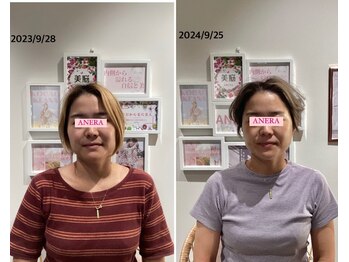アネラ(ANERA)/小顔矯正&毛穴洗浄BeforeAfter