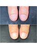 H【最強のネイルケア】噛み爪・深爪・ちび爪など爪コンプレックス解消