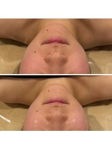 心斎橋 ルヴィ(REVI)/小顔/フェイシャル/美肌/たるみ