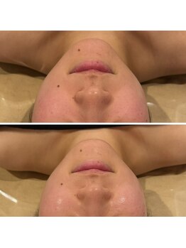 心斎橋 ルヴィ(REVI)/小顔/フェイシャル/美肌/たるみ