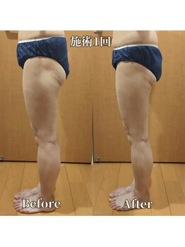 ヨサパーク サーナ 仙川(YOSA PARK Sana)/50代お客様ビフォーアフター