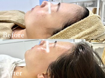 ヴィーナスプロ 岡山駅前(Venus Pro)/【顔脱毛】Before After＊