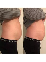 クライオ360(Cryo360)/脂肪冷却ビフォーアフター