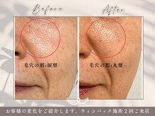 碧(ao)/ウィンバック２回の効果