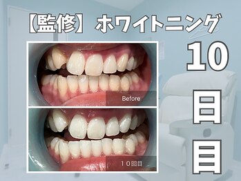 エックス(X)/【監修】ホワイトニング