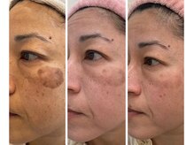 グラン ソレイユ(GRAN SOLEIL)の雰囲気（大きなシミを毎日隠すメイクから解放！シミたるみ肌改善ケア◎）