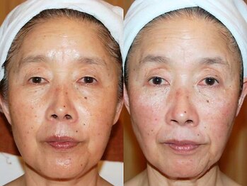 アンシャンテ 芦屋店/ 幹細胞導入フェイシャル