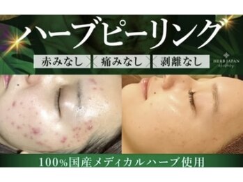 ミラ 中央林間(mira)/小顔　毛穴　ハーブピーリング