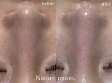 ナチュールムーン(Nature moon.)/毛穴洗浄
