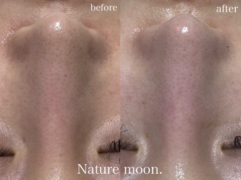 ナチュールムーン(Nature moon.)/毛穴洗浄