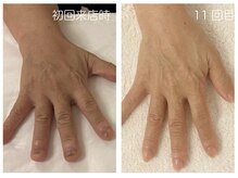 キレイテ 上野店/60代/11回目【ハンドケア上野】