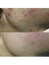 メンズサロンエヌエー(MEN'S SALON NA)/【毛穴トラブル・ニキビケア】