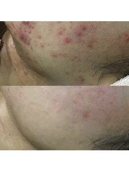 メンズサロンエヌエー(MEN'S SALON NA)/【毛穴トラブル・ニキビケア】