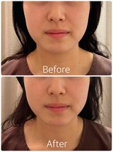 サンクエール 代官山鍼灸院(CINQ AILES)/美容鍼灸　むくみ・リフトアップ