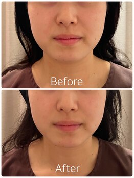 サンクエール 代官山鍼灸院(CINQ AILES)/美容鍼灸　むくみ・リフトアップ