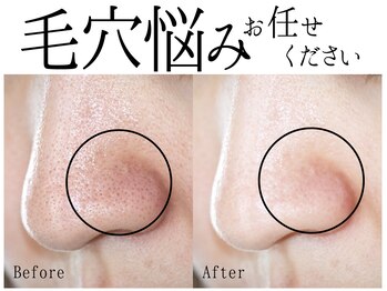 スポット 薬院駅前店(SPOT)の写真/男女ともに人気な毛穴ケアエステ!乾燥毛穴を徹底洗浄！生コラーゲンでニキビケア・角栓を克服しましょう!