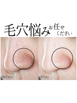 毛穴ケアをしたい
