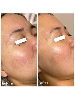 ココ(COCO)/ハーブピーリング/REVI/高知