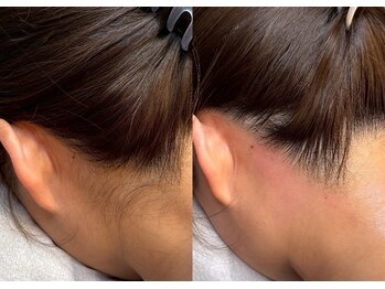 エルピス(ELPIS)/初めてのうなじ脱毛