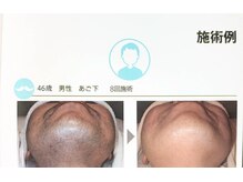 アイミービューティー(I'/me beatuy)の雰囲気(かなり濃い青ヒゲも8回の施術でかなり綺麗になりました)