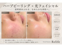 トータルビューティ リライフ(Total beauty Relife)の雰囲気（お悩みに合わせたピーリングと光フェイシャルでお肌が綺麗に）
