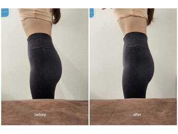 バニーヒップ(Bunny Hip)/before→after