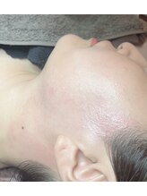 ブラジリアンワックス専門店 アンジー(ANGIE)/もみあげデザイン1