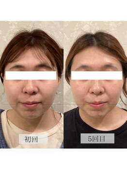 ラバ 名古屋栄店(LAVA)/小顔コルギ【むくみ・面長】