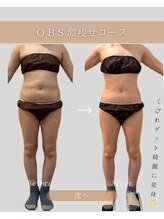 OBS新潟整骨院/新潟脂肪冷却症例数No,1