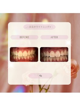 プラスビーセルフ(+b self)/ホワイトニングビフォーアフター