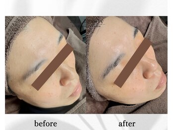 アン ビューティー(ann beauty)/施術1回【症例写真】30代