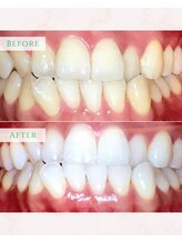 シカホワイトニングトウキョウ 笹塚店(CICA Whitening Tokyo)/ビフォーアフター（10代女性）